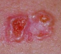 basal_cell_carcinoma_2