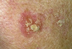 dermnet_photo_of_actinic_keratosis