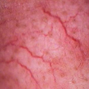 Telangiectasia