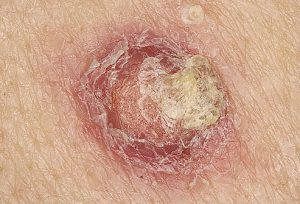 squamous