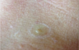 Fibromas
