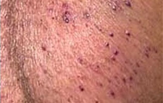 Angiokeratomas