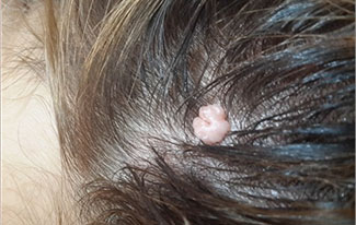 Pyogenic Granuloma