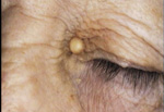 Xanthelasma