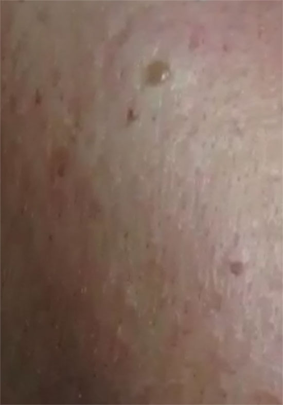 Skin Lesions