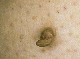 Skin Tags With Stalk