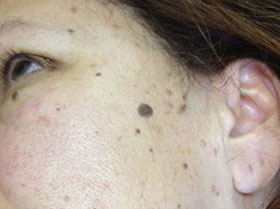 Keratoses