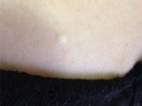Sebaceous Cyst