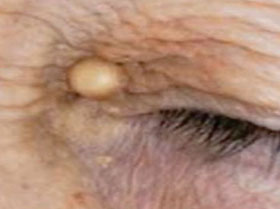 Cholesterol Deposits