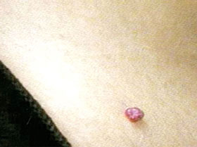Raised Angioma