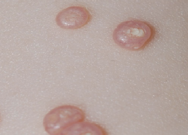 molluscum contagiosum