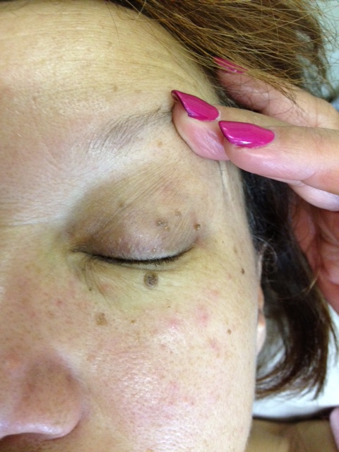 Skin Lesions