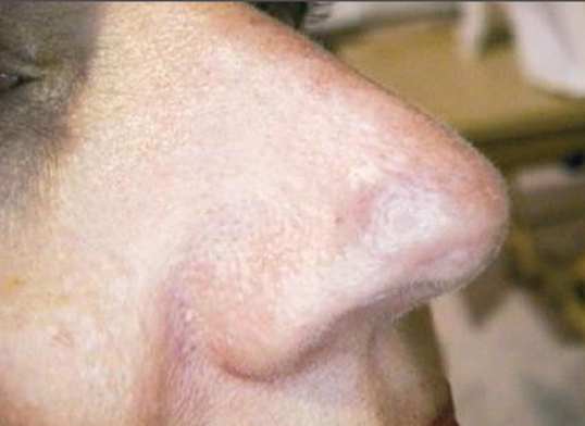 Cholesterol Deposits Removal