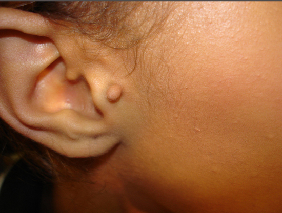 Skin Lesions