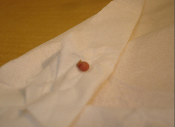 Skin Lesion Removal