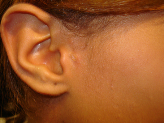 Skin Lesion Removal