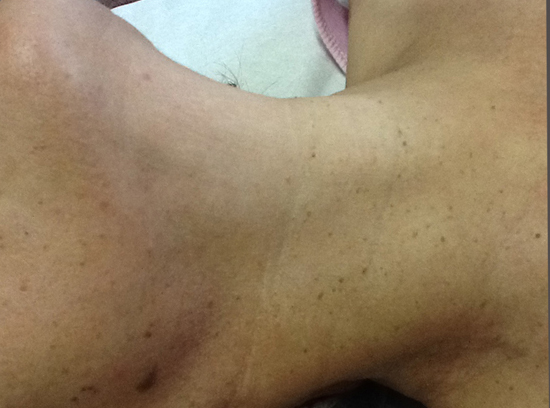 Skin Lesion Removals