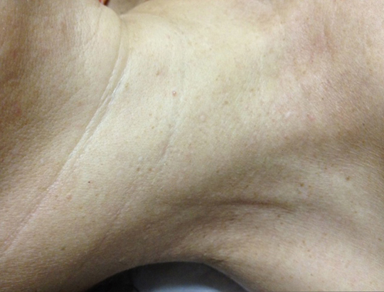 Skin Lesion Removals