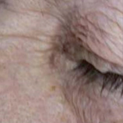 Telangiectasia