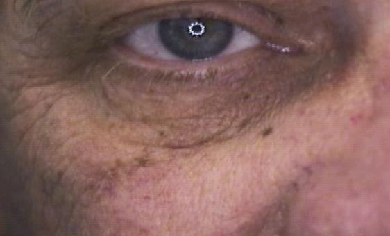 Skin Tag Removal
