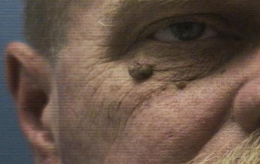 Skin Tags