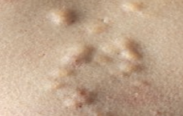 steatocytoma