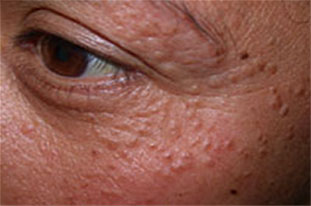 Syringoma